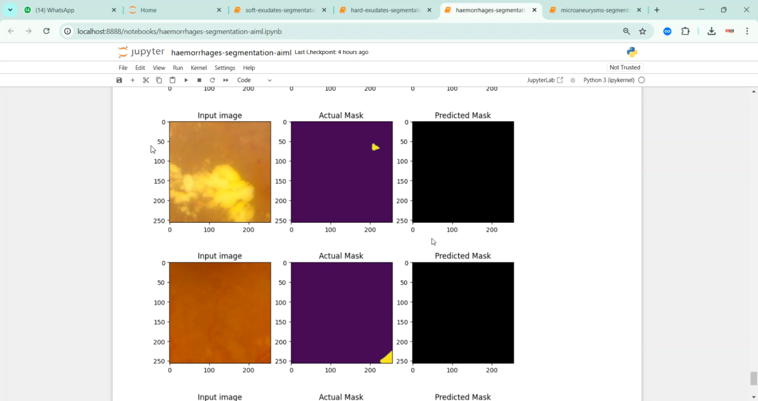 Diabetic Retinopathy Soft Exudates Segmentation Aiml in Python Projects