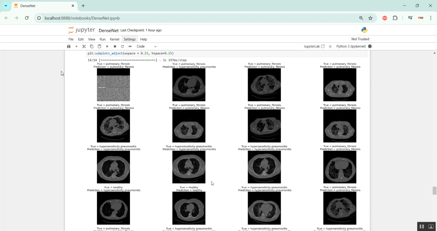 Lung Diseases Predication using DenseNet in Python Projects